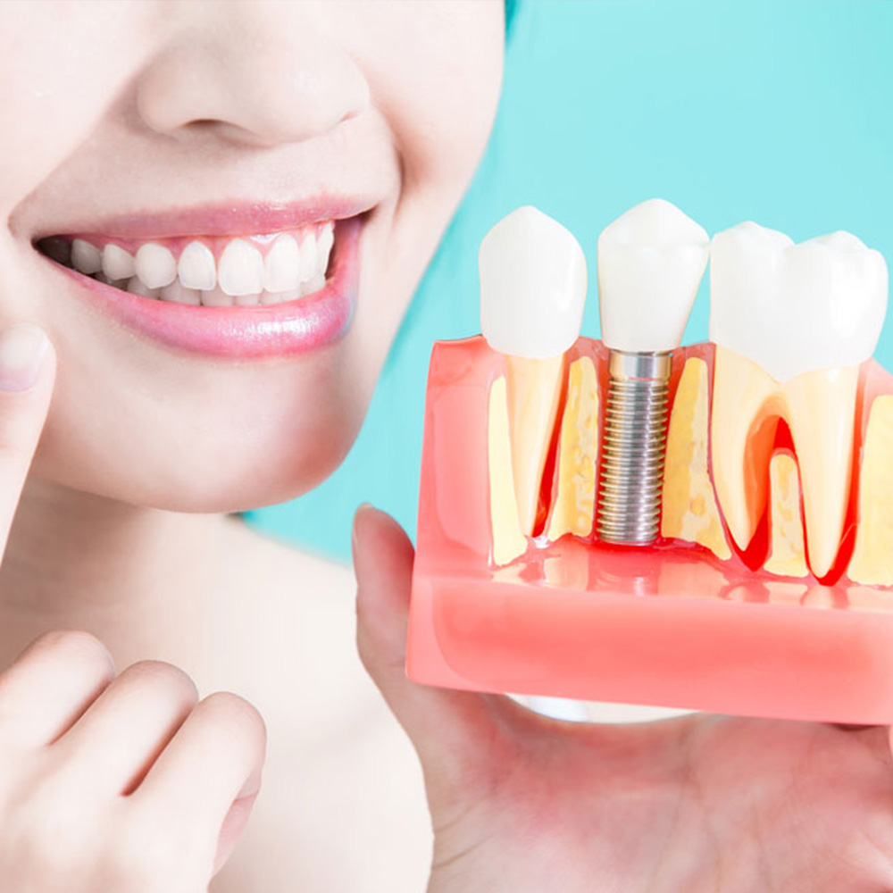 https://dentalart.al/wp-content/uploads/2024/06/Dental-Implants.jpg